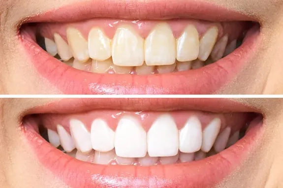 Clareamento Dental