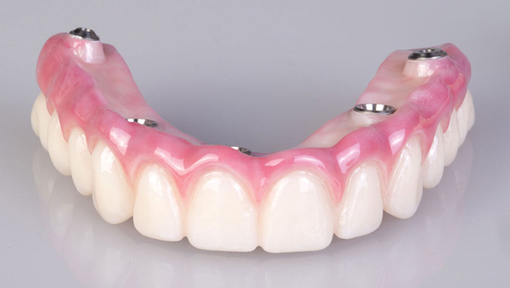 Prótese sobre Implante